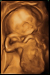 OUr baby- 18 weeks in utero